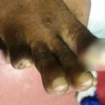 Maldives prison authority blamed for inmate’s seven-toe amputation